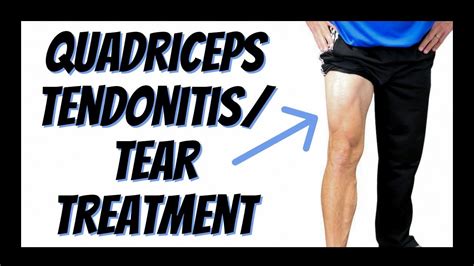 Quadriceps Tendonitis or Tear: Single Best Treatment You Can Do Yourself (Updated) - YouTube