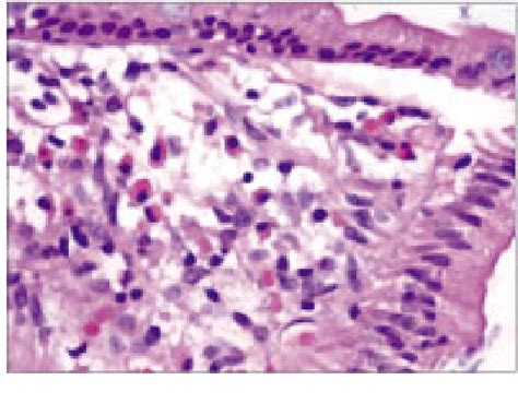 [PDF] A Case of Eosinophilic Gastroenteritis | Semantic Scholar