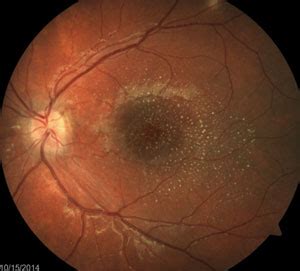 Differential Diagnosis of Retinal Disease