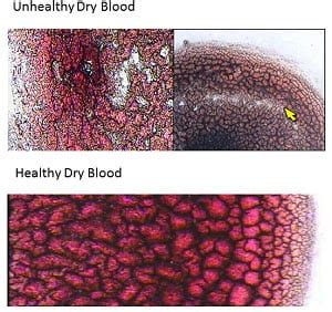 Dried Blood Cell Analysis Chart | ubicaciondepersonas.cdmx.gob.mx