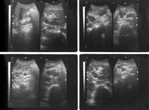 Symptoms and Signs of Retroperitoneal Fibrosis - Relief for Back Pain