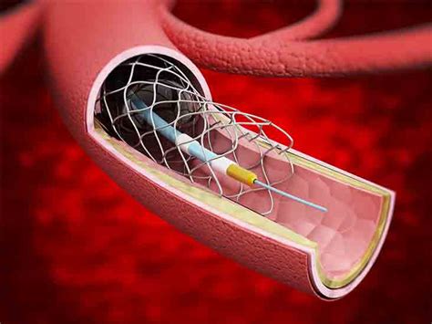 Stent: Purpose, Procedure, and Risks