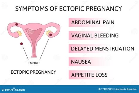 Ectopic Pregnancy Pain