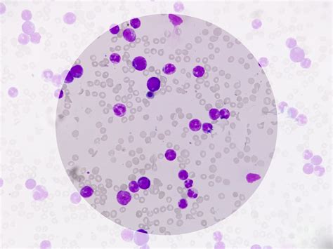 15 Leukocytes In Urine Normal Range Price Guarantee | www.micoope.com.gt