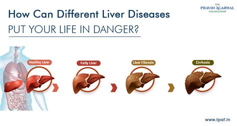 How Can Different Liver Diseases Put Your Life in Danger? - TPAF