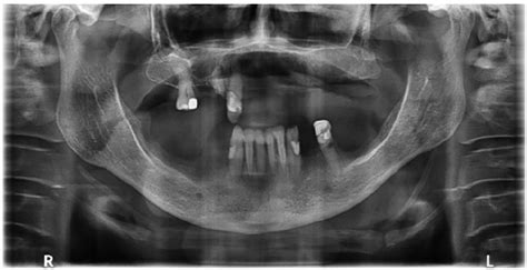 Figure 1 from Mucocele eroding maxillary sinus wall as an incidental finding in Cone-beam ...