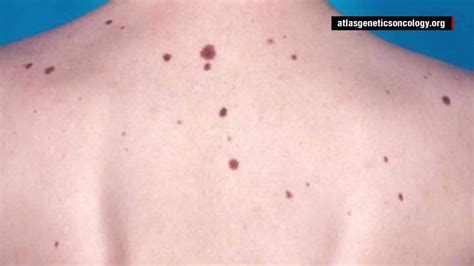 What causes melanoma? - CNN Video