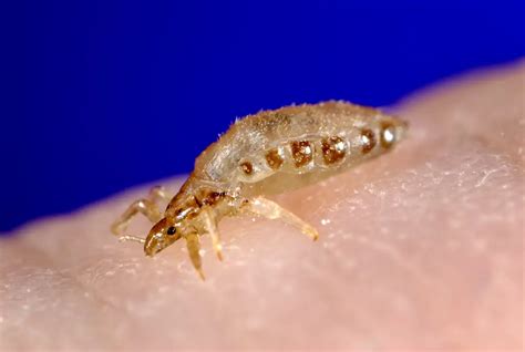 Body Lice | symptoms, diagnosis, treatment, pictures, home remedies