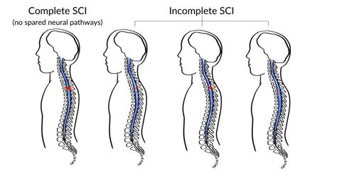 C4 Spinal Cord Injury: What to Expect & How to Recover