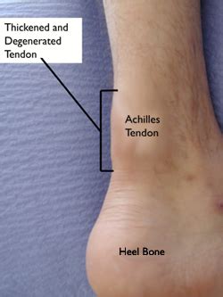 Midpoint Achilles Tendinitis - Achilles Tendinitis- Kin 480