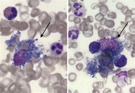 Macrophages containing blue- gray hemosiderin pigment