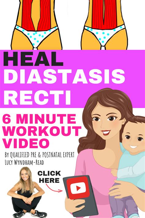 Diastasis Recti, also known as ‘Divarication of the Recti’ or DRA , is widening of the gap ...