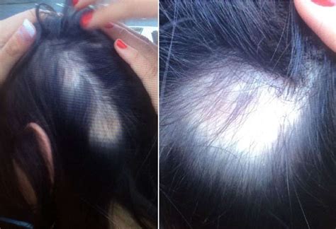 Wen Hair Care Lawsuit: See Photos of Hair Loss