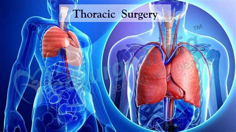 What Is Thoracic Surgery? - Prof. Dr Uwe Klima