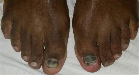 The dreaded black toenail – Runner’s toe | Diabetes Focus