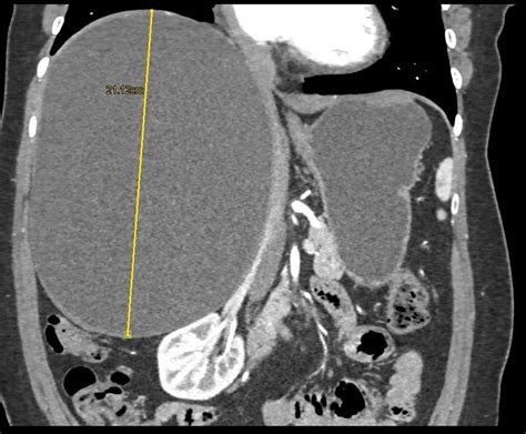 Large Simple Hepatic Cyst - Liver Case Studies - CTisus CT Scanning