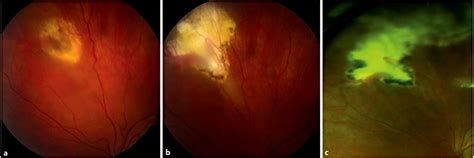 Toxoplasmosis - Pregnancy, Eye, Causes, Symptoms, Treatment