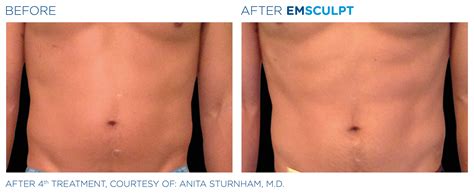 Body Sculpting Treatment: What To Do Before and After A Procedure ...