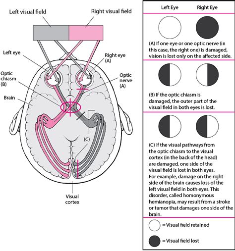 Overview of Optic Nerve Disorders - Eye Disorders - MSD Manual Consumer Version