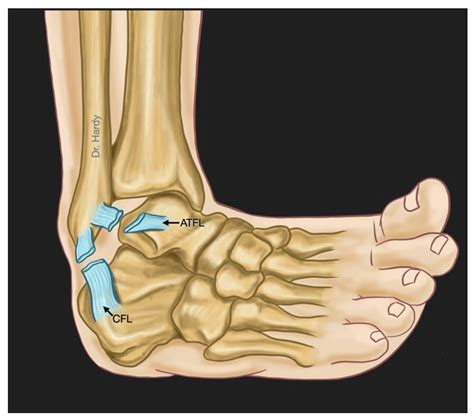 JCM | Free Full-Text | A Review of Chronic Lateral Ankle Instability and Emerging Alternative ...