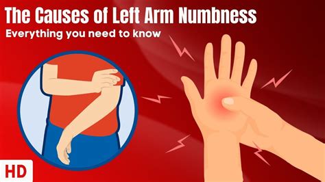 The Causes Of Left Arm Numbness - YouTube