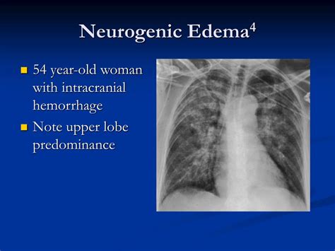 PPT - Pulmonary Edema Pathophysiological Considerations Manifestations ...