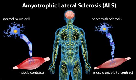 Can ALS Twitching Come Before Muscle Weakness? » Scary Symptoms