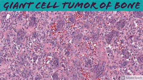 Giant Cell Tumor of Bone: Bone Pathology Basics - YouTube