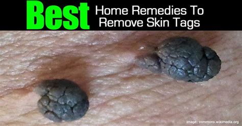 Best Home Remedies To Remove Skin Tags - Natural Solution Today | Skin ...