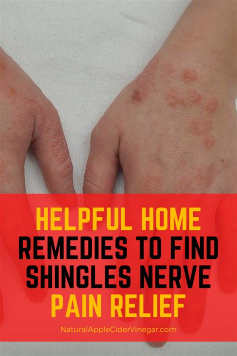 Pin on Natural Shingles Relief