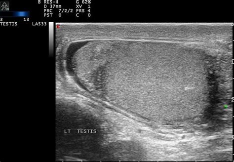 Normal Epididymis Ultrasound