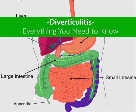 Diverticulosis, digestive System, esophagus, Human digestive system, Gastrointestinal tract ...