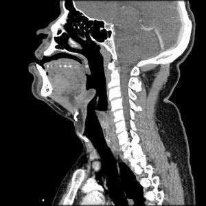 Differential Diagnosis of Epiglottitis