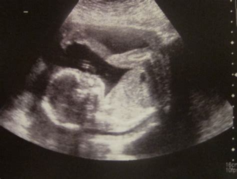 Our Life Unedited: News of the ultrasound sorts