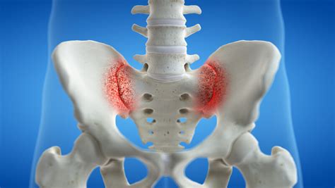 How Long Does A Sprained Sacroiliac Joint Take To Heal - Damian Moore Kapsels