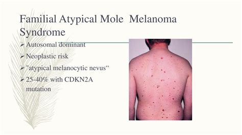 Malignant Melanoma - презентация онлайн