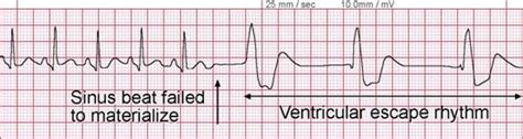 Ventricular Escape Beat ECG