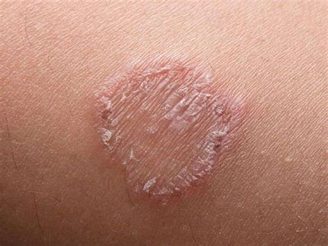 Ringworm In Humans: All About Ringworm In Humans