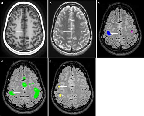 Functional MRI in a 26-year-old man with focal cortical dysplasia,... | Download Scientific Diagram