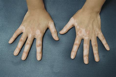 Eczema and Hypopigmentation: Does Eczema Cause Hypopigmentation?