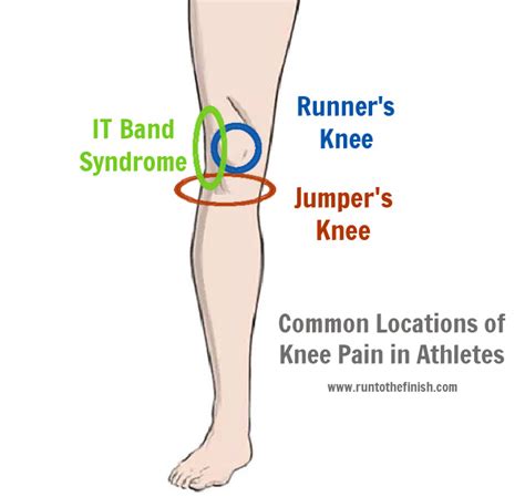 Treatment for Runner’s Knee vs. Jumper’s Knee