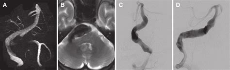 (A) MRI showing a large dolichoectatic vertebrobasilar aneurysm. (B)... | Download Scientific ...