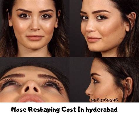 Nose Reshaping Surgery to Improve the Shape of Your Nose | by naresh ...