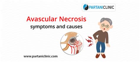 Avascular necrosis: diagnosis and treatment | Partani Clinic