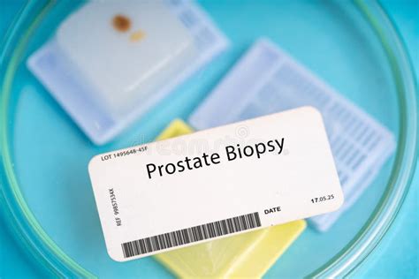 Prostate Biopsy stock photo. Image of sample, medical - 275972426