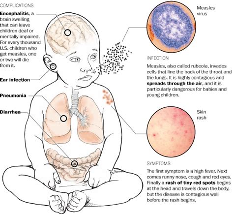 Measles: May 2015