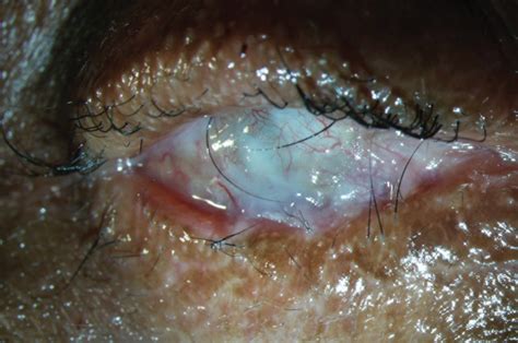 Ocular Cicatricial Pemphigoid (OCP): management strategies