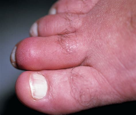 Why Is This Man’s Toe Painful, Swollen, and Red? | Consultant360