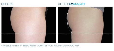 EMSCULPT | BUILD MUSCLE + BURN FAT IN CHICAGO