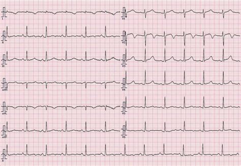 The electrocardiography. Lead I and aVL presented T wave inversion but ...